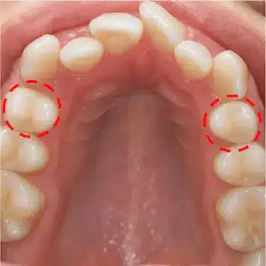 Vista superior del maxilar con extracciones dentales en premolares para tratamiento de ortodoncia