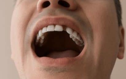 Paciente con diente frontal ausente para ilustrar el impacto estético de la pérdida dental