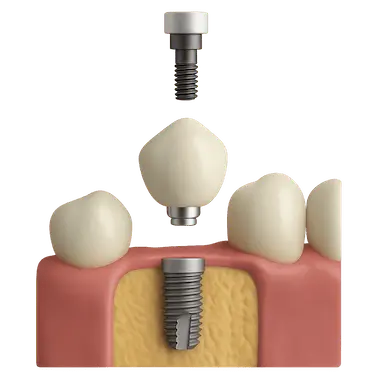 Fase protésica del implante dental con ajuste de la corona sobre el implante integrado en Madrid