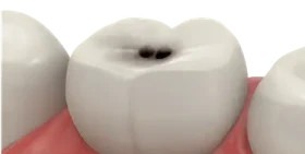 Diente con caries profunda y estructura dañada antes de la colocación de un implante dental