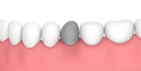 Representación de un diente oscuro por traumatismo que puede requerir implante dental