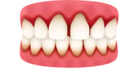 Dentadura con encías retraídas y pérdida ósea por periodontitis que puede requerir implante dental