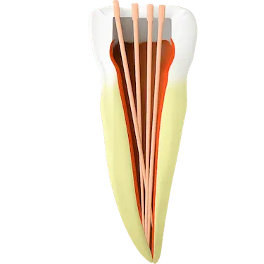 Instrumentos dentro del diente eliminando la infección y limpiando los conductos radiculares
