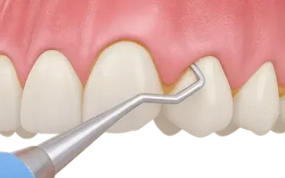 Tratamientos de odontología conservadora en Murcia para cuidar y mantener los dientes naturales
