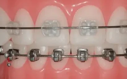 Brackets metálicos y estéticos en tratamiento de ortodoncia en Clínica Dr. Ferrer Murcia
