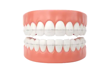 Brackets estéticos transparentes en modelo dental de ortodoncia estética en Murcia Dr. Ferrer