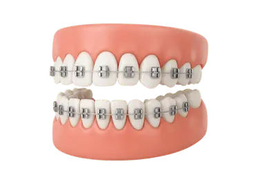 Tratamiento de ortodoncia tradicional con brackets para corregir la alineación dental