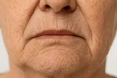 Primer plano de reabsorción ósea por pérdida dental con necesidad de implantes