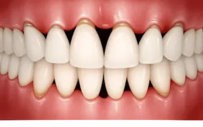Tratamiento de periodoncia en Madrid con encías sanas y dientes limpios, Dr. Ferrer