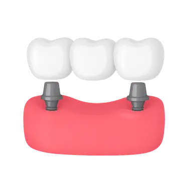 Puente dental fijo sobre 2 implantes con 3 coronas para el reemplazo de tres dientes perdidos