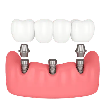 Puente dental fijo sobre tres implantes con cuatro coronas en arcada parcialmente desdentada