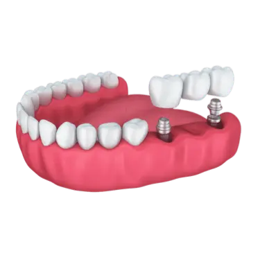 Prótesis parcial fija sobre implantes dentales con puente atornillado sobre dos implantes