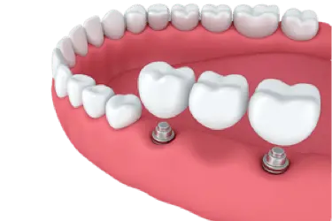 Puente dental de tres coronas sobre dos implantes en arcada inferior en clínica Dr. Ferrer Murcia