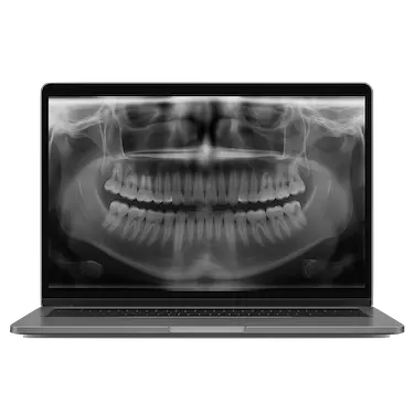 Radiografía panorámica o periapical para el diagnóstico de endodoncia dental en Madrid