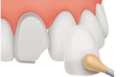 Aplicación de carilla dental sobre diente fracturado para restaurar forma y color en Murcia