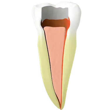 Diente sellado tras limpiar los conductos en una endodoncia en Madrid
