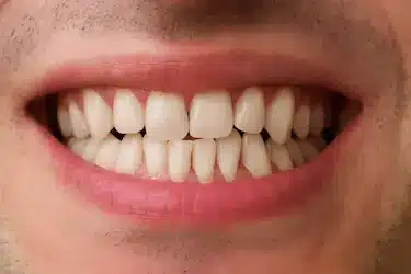 Solución para dientes torcidos con tratamiento de ortodoncia que mejora la alineación dental