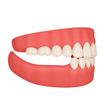 Ilustración de ausencia de dientes posteriores tratable con implantes dentales