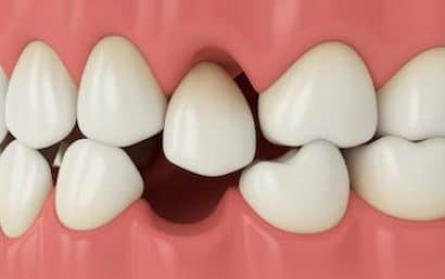 soluciones con implantes dentales para reemplazar dientes perdidos
