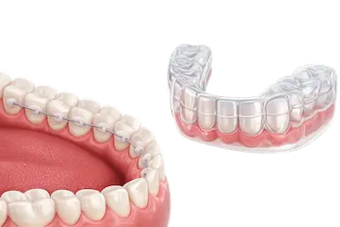 Imagen 3D de retenedor fijo y retenedor transparente para explicar la duración del tratamiento