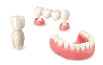 Tipos de prótesis dentales sin implantes sobre dientes y encía en clínica dental de Madrid
