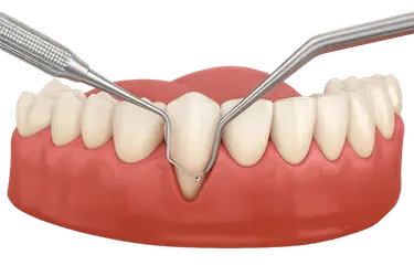 Cirugía periodontal avanzada para eliminar bolsas profundas y estabilizar las encías en Murcia