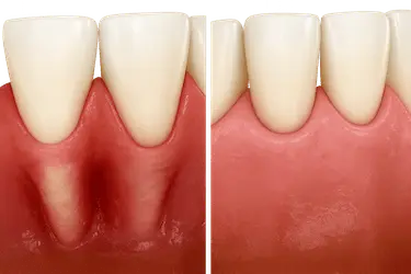 Cirugía de colgajo dental para limpiar raíces y eliminar bolsas periodontales profundas en Madrid.
