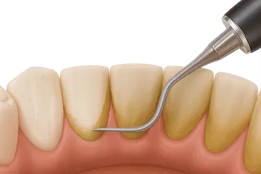 Curetaje dental profesional para eliminar sarro bajo la encía en Clínica Dental Medics Murcia