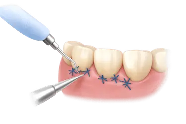 Cirugía periodontal para eliminar bolsas periodontales y regenerar encías en Madrid