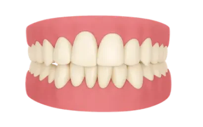 Sonrisa con dientes amarillos antes del blanqueamiento dental profesional en Murcia