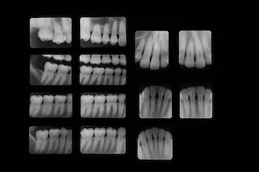 Valoración periodontal con estudio radiológico y diagnóstico completo en clínica dental de Murcia