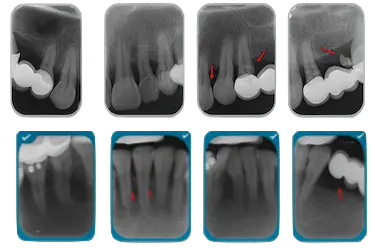 Radiografía dental con estudio periodontal completo en Clínica Dental Medics Dr. Ferrer Madrid.