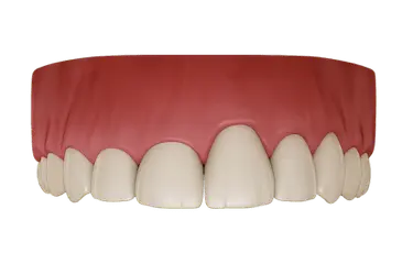 Procedimiento de gingivectomía con láser para mejorar la salud y estética gingival en Madrid.