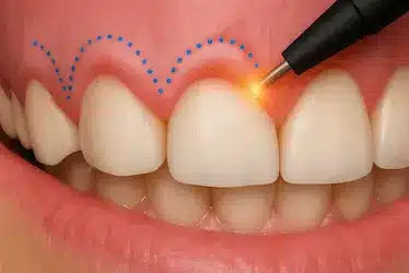 Gingivectomía con láser en Murcia para remodelar encías y mejorar la salud bucal