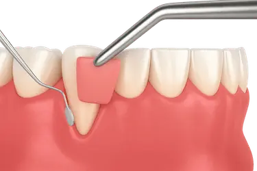 Injerto de encía para recubrir raíces expuestas y fortalecer el tejido gingival en Madrid.