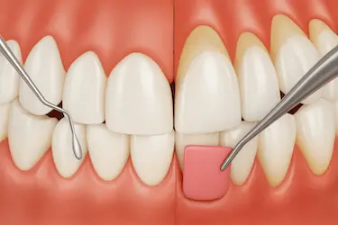 Injerto de encía para cubrir raíces expuestas y fortalecer el tejido blando en clínica de Murcia