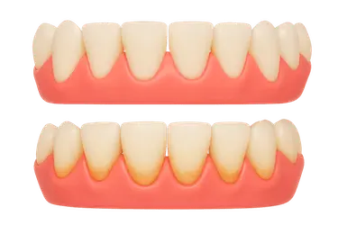 Mantenimiento periodontal para conservar encías sanas y prevenir la periodontitis