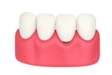 Tratamiento de periimplantitis para eliminar la infección alrededor del implante dental en Madrid.
