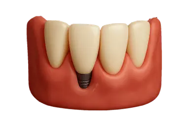 Tratamiento de periimplantitis para eliminar la infección y proteger implantes dentales en Murcia