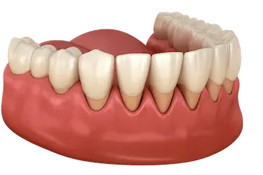 Tratamiento periodontal para frenar la retracción de encías y mantener los dientes firmes