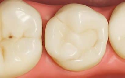 Diente tratado con empaste estético dentro de los tratamientos de odontología conservadora