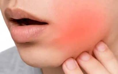 Absceso dental o flemón con hinchazón visible en la mejilla y dolor intenso en el diente.