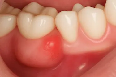 Absceso gingival con hinchazón localizada y presencia de pus en la encía