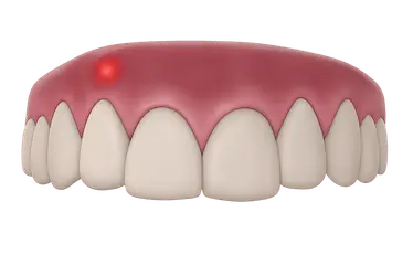 Absceso periapical con acumulación de pus en la raíz del diente