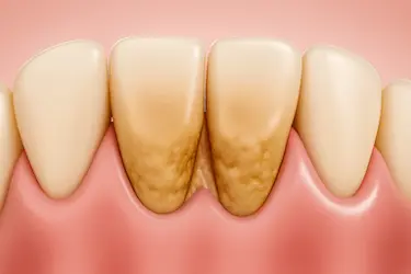 Acumulación de sarro y placa bacteriana que puede causar abscesos dentales o flemones