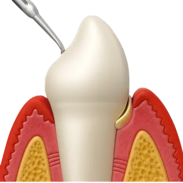 Alisado radicular en encías para eliminar bacterias y suavizar la raíz dental en Madrid