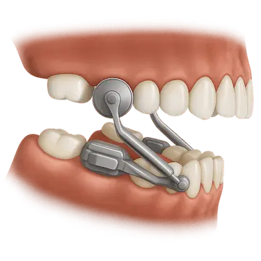 Aparato Herbst representado en ambos maxilares para corregir mandíbulas retrasadas en niños
