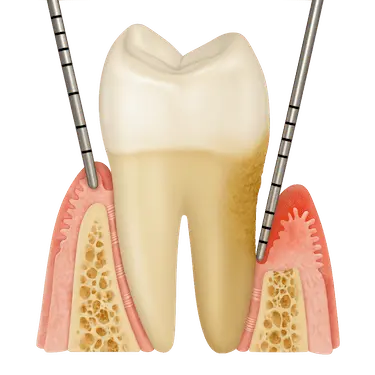 Bolsas periodontales medidas con sonda dental antes del curetaje