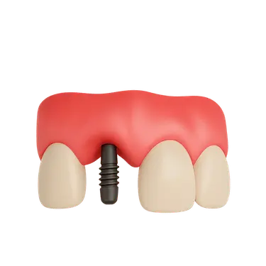 Colocación de implante dental en incisivo superior durante un tratamiento en Madrid