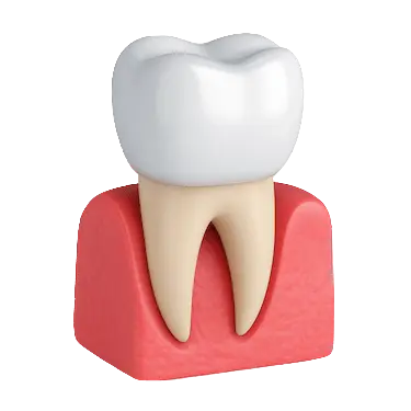 Corona dental sobre diente natural en Madrid, tratamiento fijo para restauración dental